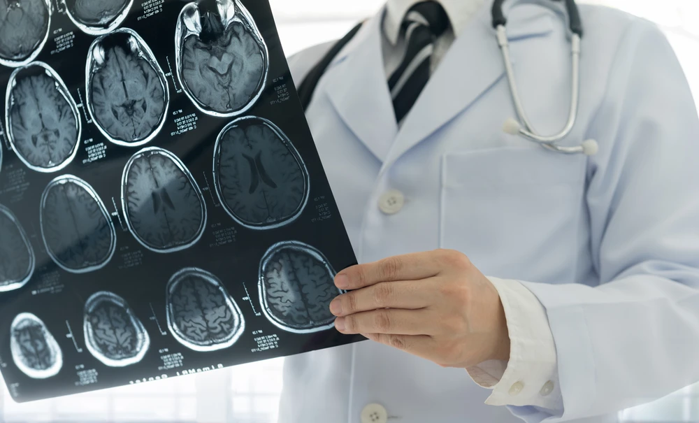 When Seconds Count: The Devastating Consequences of Stroke Misdiagnosis