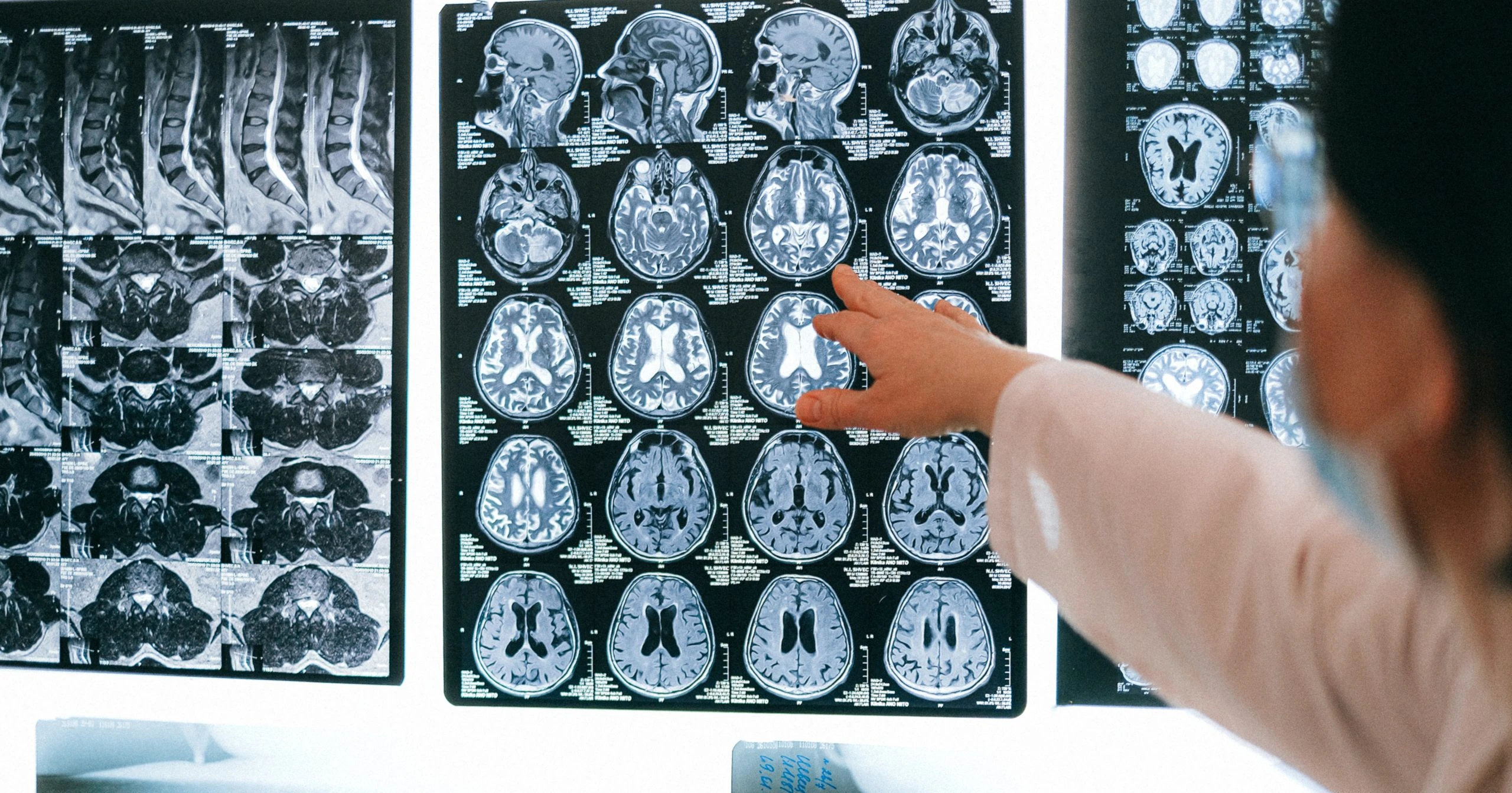 Palm Beach County Comprehensive Stroke Centers
