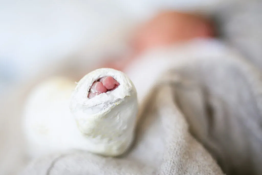 Clubfoot and Other Musculoskeletal Birth Injuries in Florida